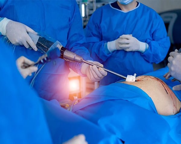 Cirugía Laparoscópica de Vesícula Guayaquil Cirugía Laparoscópica Vesicula Guayaquil Dr Ricardo Garcia-min