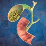 Cirugía de Vesícula Guayaquil Dr Ricardo Garcia Cirujano General Clinica Kennedy-min