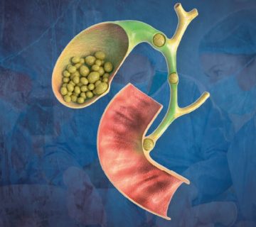 Cirugía de Vesícula Guayaquil Dr Ricardo Garcia Cirujano General Clinica Kennedy-min