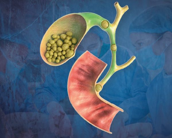 Cirugía de Vesícula Guayaquil Dr Ricardo Garcia Cirujano General Clinica Kennedy-min