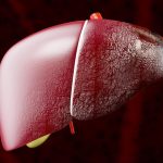 Daño hepático Tratamiento Guayaquil Dr Ricardo García-min