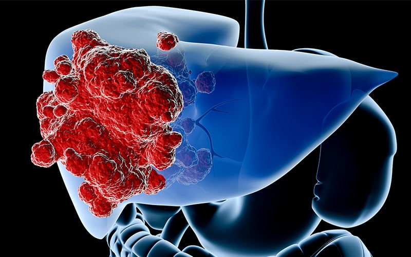 Cáncer de Higado Cirrosis Tratamiento Cirugía Guayaquil Dr Ricardo García-min