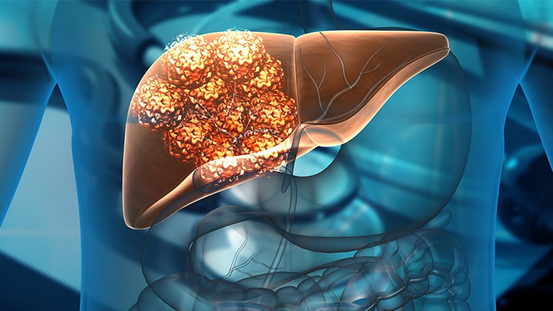 Cáncer de Higado Tratamiento Guayaquil Dr Ricardo García-min