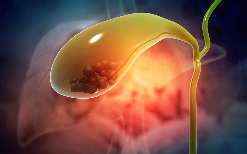 Cirugía de vesícula Guayaquil Dr Ricardo Garcia Cirujano General Clinica Kennedy-min