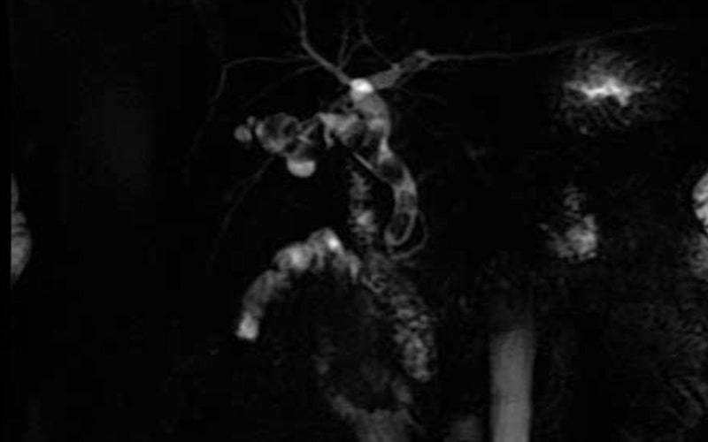 Coledocolitiasis Calculos Vias Biliares Cirujano Guayaquil Dr Ricardo Garcia Clínica Kennedyjpg