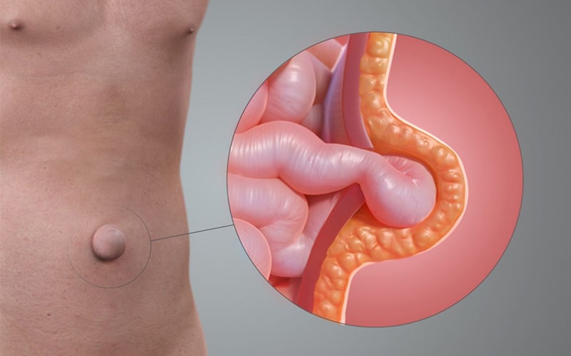 Hernia umbilical cirujano guayaquil Dr Ricardo Garcia Cirujano Clinica Kennedy-min