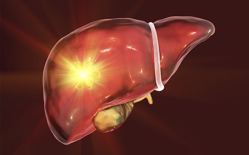 Tumores benignos de hígado tratamiento Guayaquil Dr Ricardo Garcia Clínica Kennedy Cirujano General-min